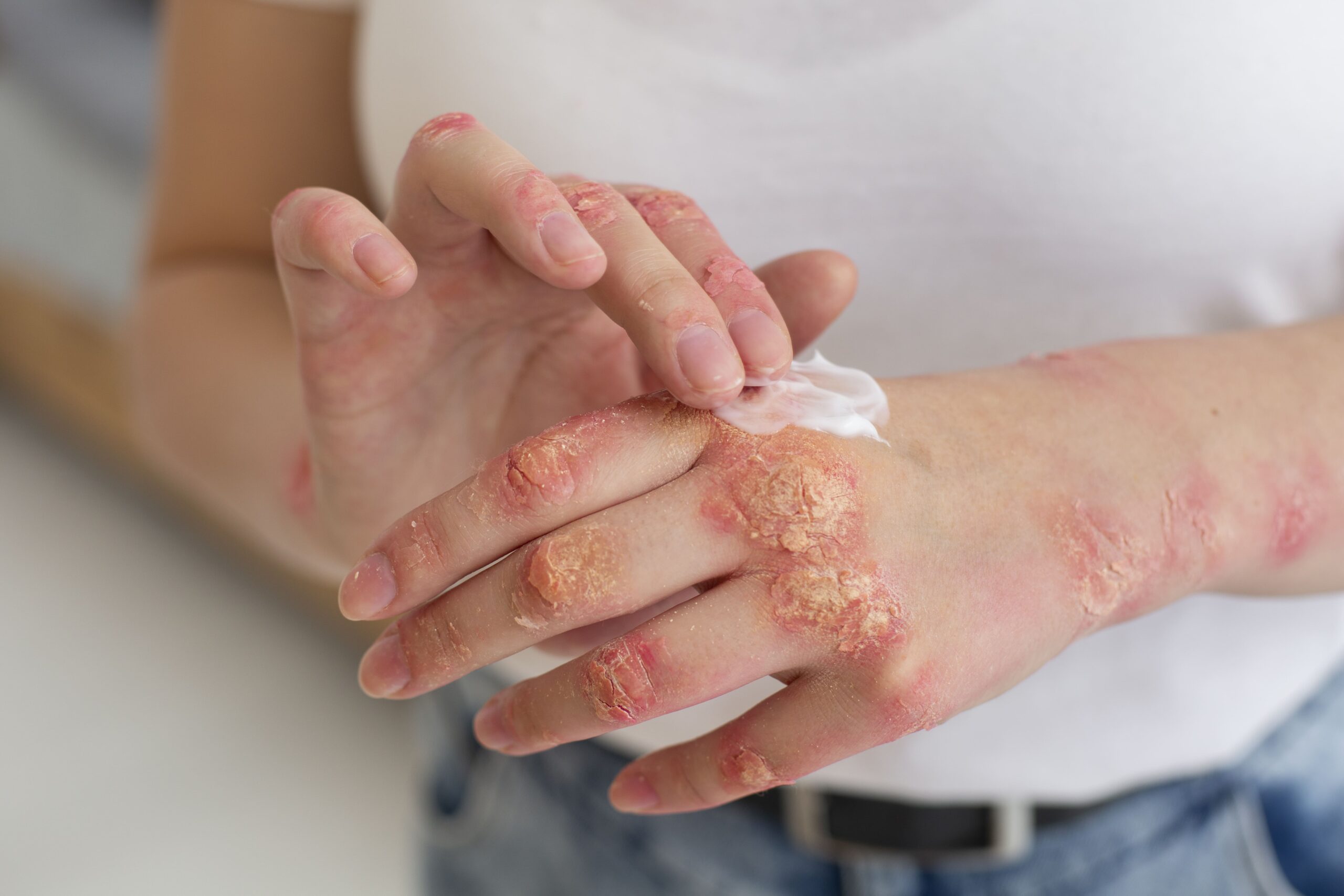 Mulher com psoríase aplicando tratamento tópico nas mãos