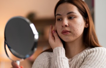 Adolescente com acne segurando espelho.